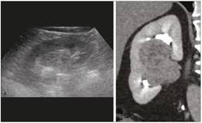 Hypertrophic Column Of Bertin – Nephropocus