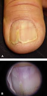 Pdf) Painful Nail With Longitudinal Erythronychia