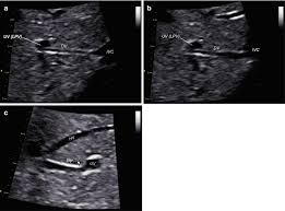 Why Does Blood Flow To A Fetus Bypass Its Liver? - Quora